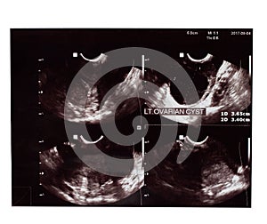 The Film Ultrasound, ovarian cysts,Internal organs examination for women