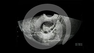 Film Ultrasound, ovarian cysts,Internal organs examination for women
