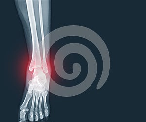 Film x-ray Ankle and Foot fracture distal fibula bone with soft tissues swelling on red mark.Medical healthcare concept photo
