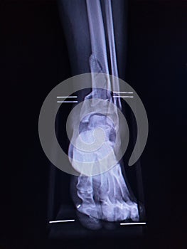 Film Ankle joint AP Case fracture distal metaphysis of distal tibia and fibula.Medical image concept.