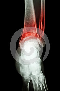 Film x-ray ankle show fracture distal tibia and fibula (leg's bone) photo