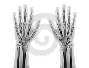 Film x-ray of both normal human hands . front view