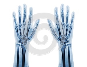 Film x-ray of both normal human hands . front view