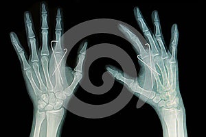 Film x-ray of hand fracture : show fracture metacarpal bone insert with k-wire photo