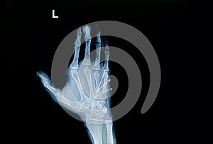 Film x-ray of hand fracture : show fracture metacarpal bone photo