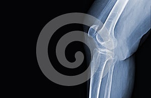 x-ray of human knee normal joints and ligaments Medical image concept