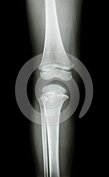 Film x-ray knee AP(antero-posterior) of child