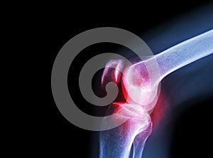 Film x-ray knee joint with arthritis ( Gout , Rheumatoid arthritis , Septic arthritis , Osteoarthritis knee ) and blank area at le photo