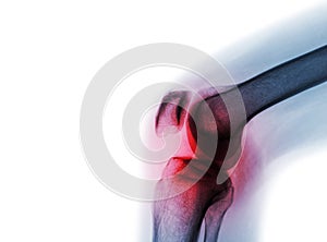 Film x-ray knee joint with arthritis & x28; Gout , Rheumatoid arthritis , Septic arthritis , Osteoarthritis knee & x29;