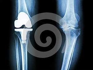 Film x-ray knee of osteoarthritis knee patient and artificial joint