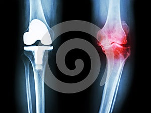 Film x-ray knee of osteoarthritis knee patient and artificial joint photo