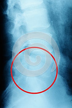 Film x-ray lumbar spine , L-S spine AP,Lateral view Grade spondylolithesis of L5-S1 , Decresed height of intervertebral disc space