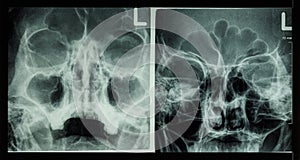 Film x-ray paranasal sinus show frontal sinus , maxillary sinus , ethmoid sinus photo
