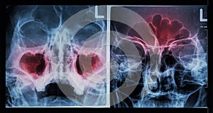Film X-ray paranasal sinus : show sinusitis at maxillary sinus ( left image ) , frontal sinus ( right image ) photo