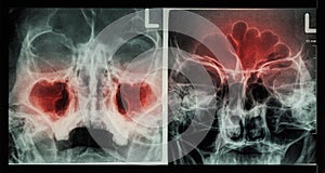 Film X-ray paranasal sinus : show sinusitis at maxillary sinus ( left image ) , frontal sinus ( right image ) photo