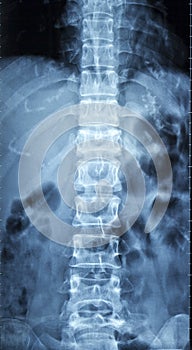 Film x-ray spine