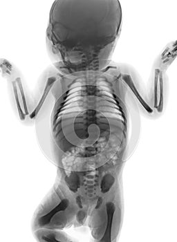 Film x-ray whole body of normal infant . front view