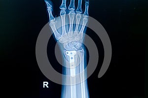 Film x-ray wrist fracture : show fracture distal radius photo