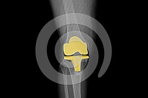 A film xray of a knee of a patient after total knee prosthesis replacement