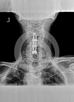 Film xray or radiograph of a cervical neck. AP anterior posterior view showing surgical bracket to help stabilize the patients