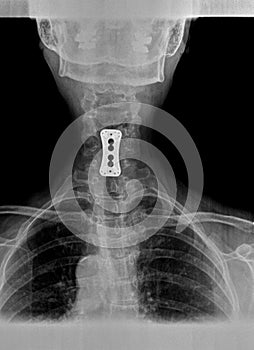 Film xray or radiograph of a cervical neck. AP anterior posterior view showing surgical bracket to help stabilize the patients