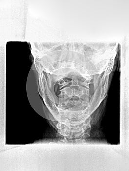 Film xray or radiograph of a cervical neck. AP open mouth anterior posterior view which is the best way to see the C1 Atlas and C2 photo
