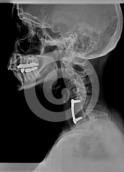 Film xray or radiograph of a cervical neck. Lateral side view showing surgical bracket to help stabilize the patients neck photo