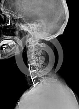 Film xray or radiograph of a cervical neck. Lateral side view showing surgical bracket to help stabilize the patients neck