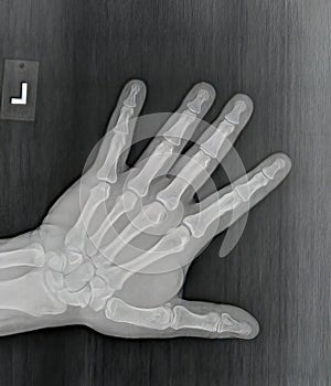 Film xray or radiograph of a normal left hand of an adult male. AP view show humans hand. normal bone structure of all phalanges