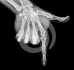 Film xray x-ray or radiograph of a thumb and finger in gestural language, manual communication, or signing aka sign language,