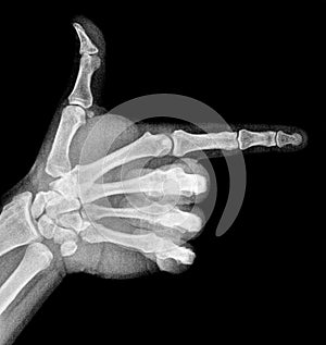 Film xray x-ray or radiograph of a thumb and finger in gestural language, manual communication, or signing aka sign language,