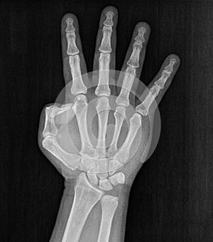 Film xray x-ray or radiograph of a hand and fingers showing the number four 4 in gestural language, manual communication, or