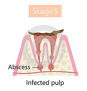 the final stage of tooth decay, abscess formation. Dental and oral health care concept