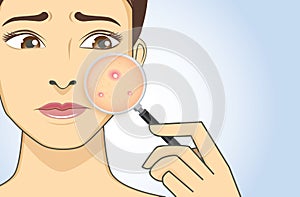 Finding acne with magnifier