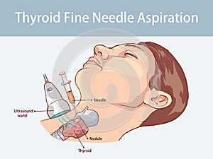 Fine Needle Aspiration of Thyroid Nodules photo