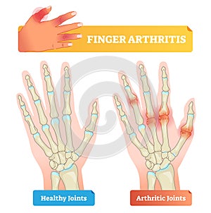 Finger arthritis vector illustration. Healthy and disease affected joints.