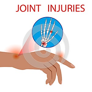 Finger Dislocation human medical organ vector illustratio.