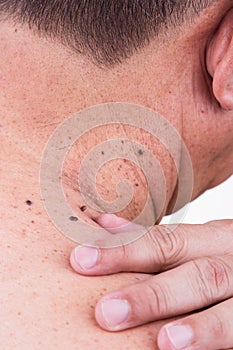 Finger embrace mole on neck and shoulder of Asian male