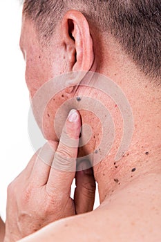 Finger embrace mole on neck and shoulder of Asian male