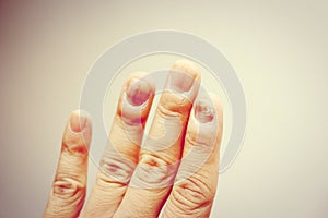 Finger with onychomycosis. A toenail fungus. - soft focus photo