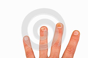 Fingernails with nail fungus