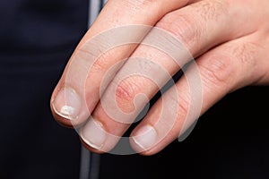 Fingernails showing signs of calcium deficiency