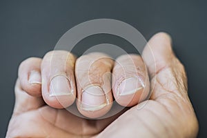 Fingers with dry fingernails On gray background