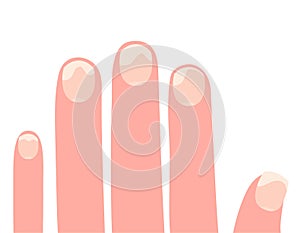 Fingers of the left hand with affected nails cartoon vector illustration