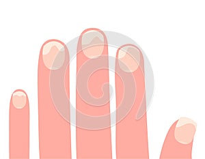 Fingers of the left hand with affected nails cartoon vector illustration photo