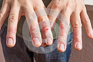 Fingers of man with eczema