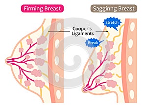 Firm and sagging breasts illustration. womenâ€™s beauty body care concept