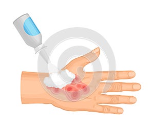 First Aid for Hand with Ambustion or Burn on the Skin Vector Illustration