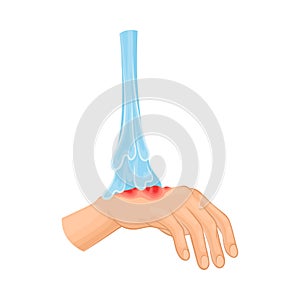 First Aid for Hand with Ambustion or Burn on the Skin Vector Illustration