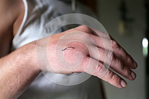 Fish Hook Embedded into skin of Man`s Hand